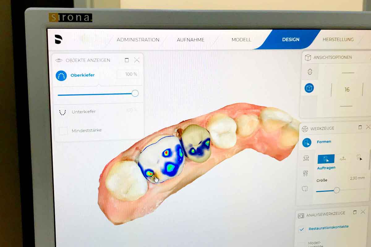 Cerec Behandlung Zahnarzt Details