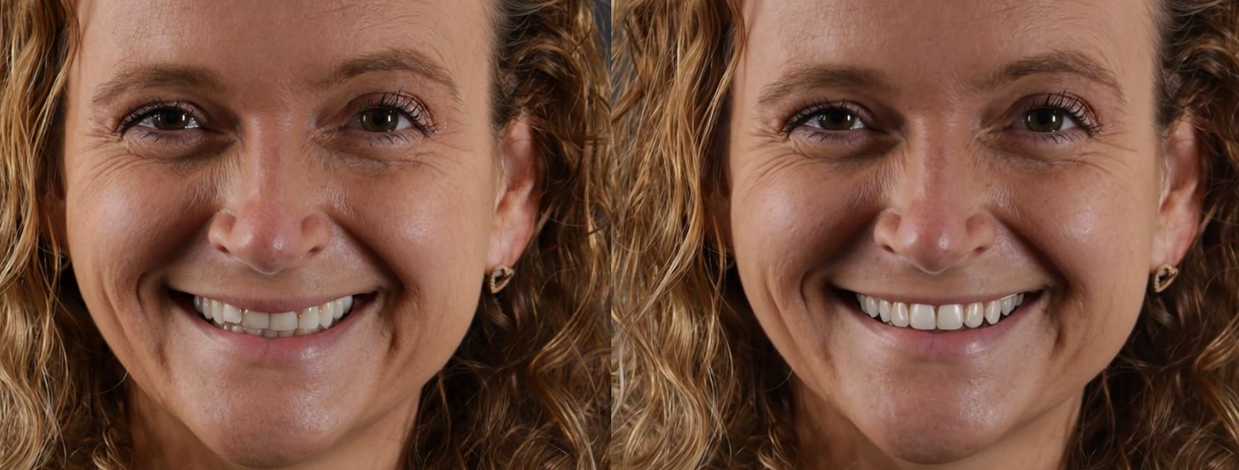 Zahnarzt Paderborn Annika vorher/nachher