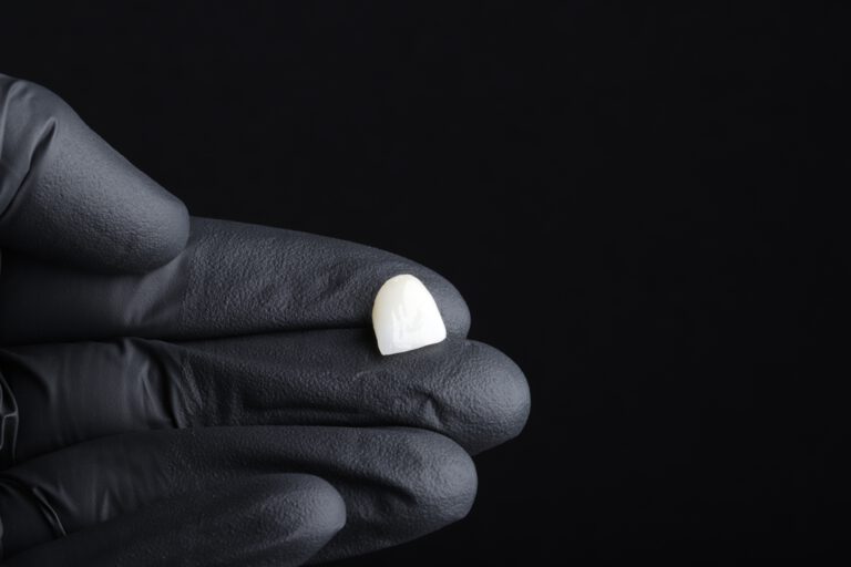 Zahnarzt Paderborn Non prep Veneer